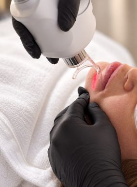 PRP und fraktionierter CO2-Laser im Gesicht - Hauterneuerung bei D DERMA Aesthetics in Berlin