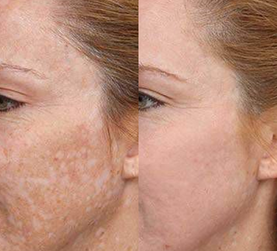 Pigmentflecken loswerden mit Mesotherapie