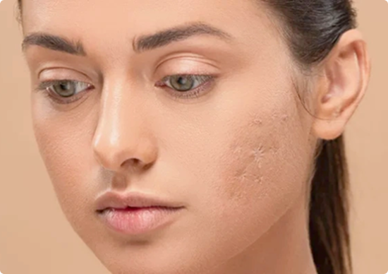 RF-Needling bei Aknenarben