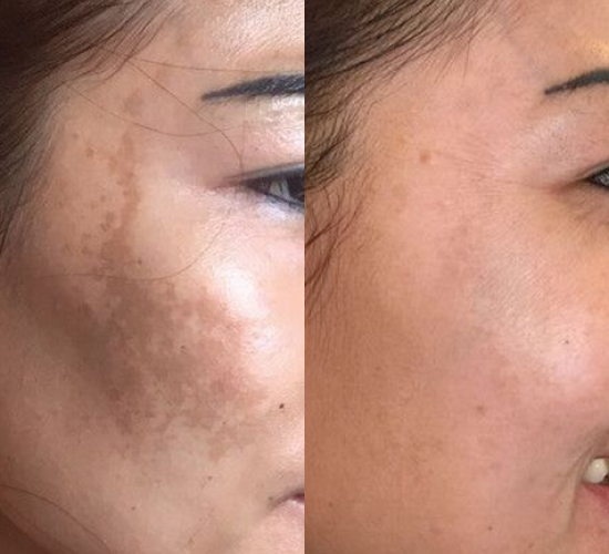 YAG Laser (Kaltlaser)