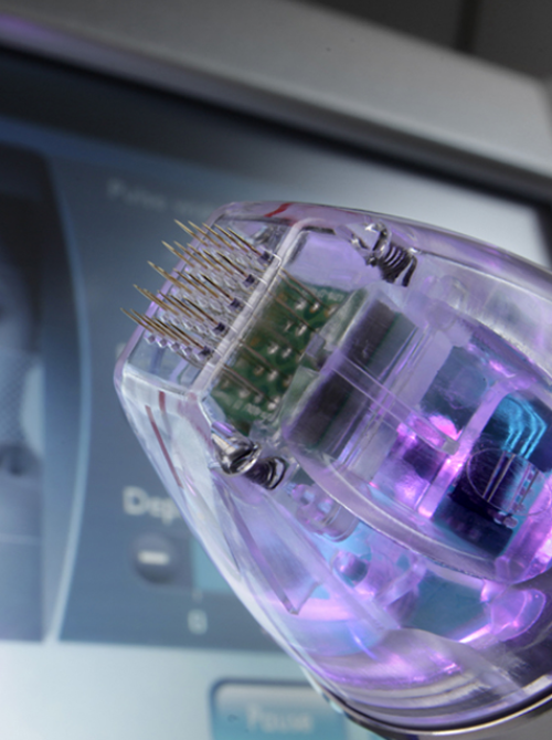 Wie funktioniert RF-Needling