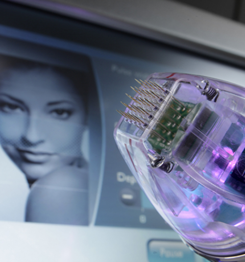 Was macht RF-Needling mit Aknenarben