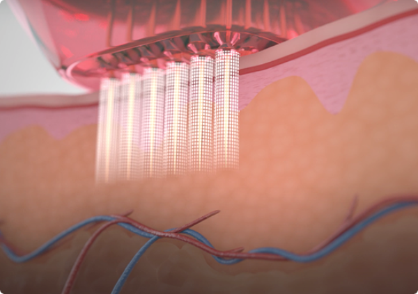 Bye-Bye Cellulite: RF-Needling + PB Serum Lipase