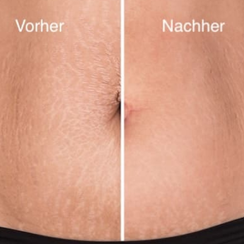 RF-Needling am Bauch vorher nachher