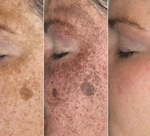 Super Veloce IPDL oder BBL