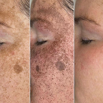 Pigmentflecken loswerden - Welche Methoden helfen wirklich?