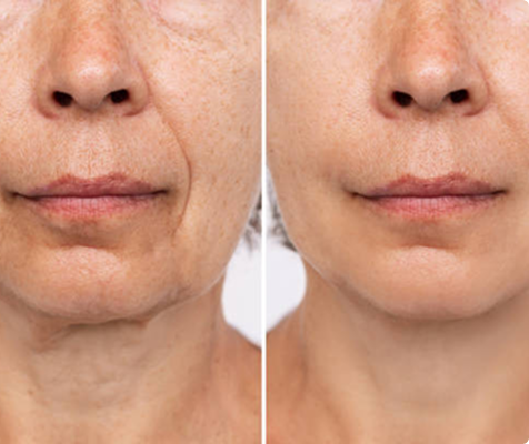 RF-Needling beim Doppelkinn