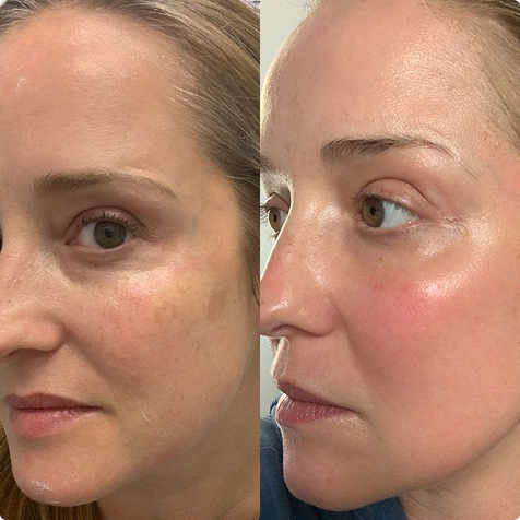 Peeling mit speziellen Säuren