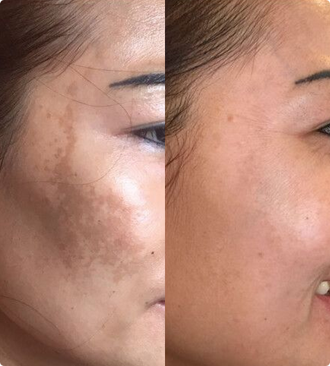 YAG Laser (Kaltlaser)