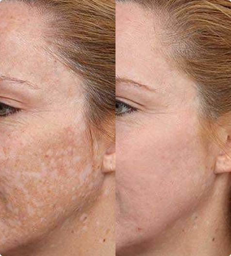 Pigmentflecken loswerden mit Mesotherapie