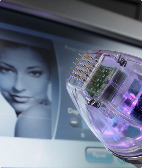 Was macht RF-Needling mit Aknenarben