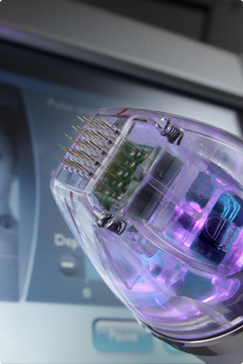 Wie funktioniert RF-Needling