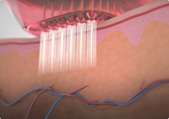 Bye-Bye Cellulite: RF-Needling + PB Serum Lipase