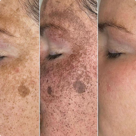 Super Veloce IPDL oder BBL