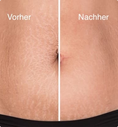 RF-Needling am Bauch vorher nachher