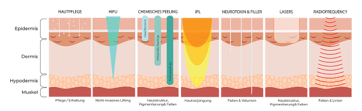 IPDL / BBL Wirkprinzip