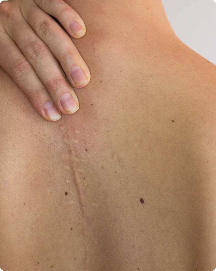 Narbenbehandlung am Körper