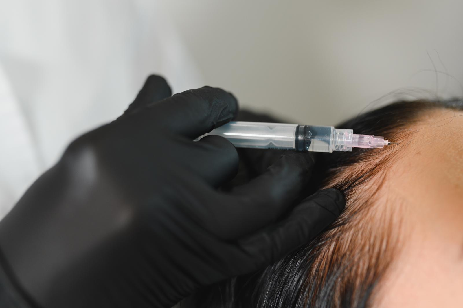 Mesotherapie für Haare Behandlung in Berlin