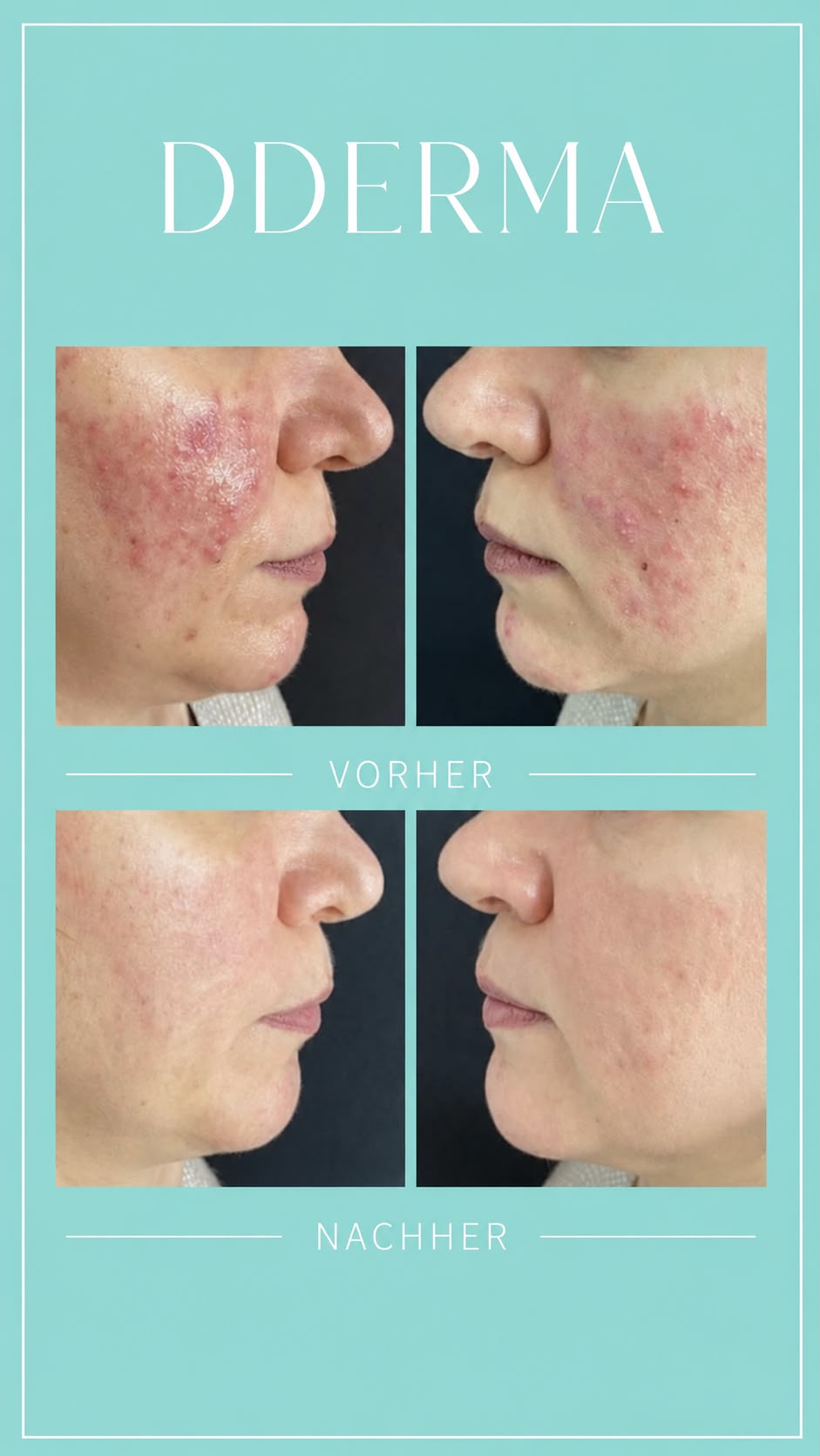 IPDL Vaskulär Berlin – Vorher-Nachher: Behandlung von Rosacea