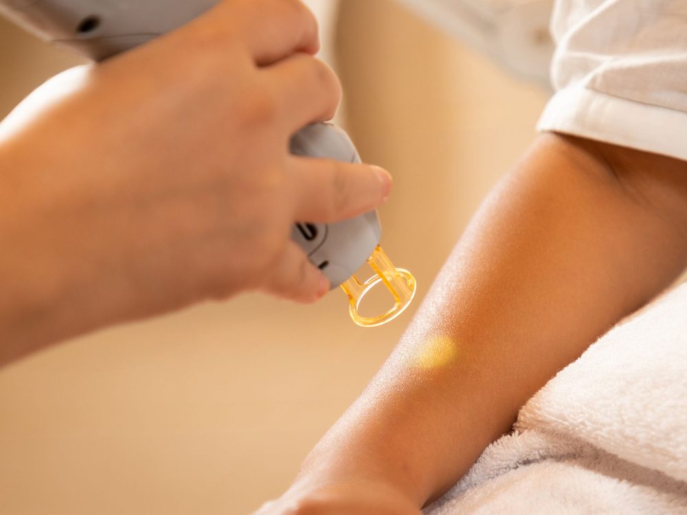 Laser-Haarentfernung am Arm – Behandlungsablauf bei D DERMA in Berlin