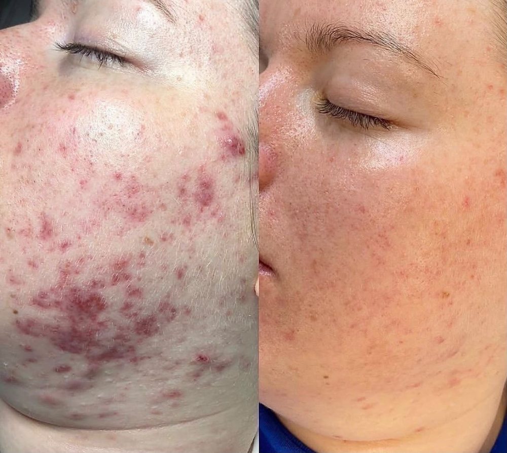 Entzündliche Akne an der Wange vor und nach begleitender Phototherapie bei D DERMA Aesthetics