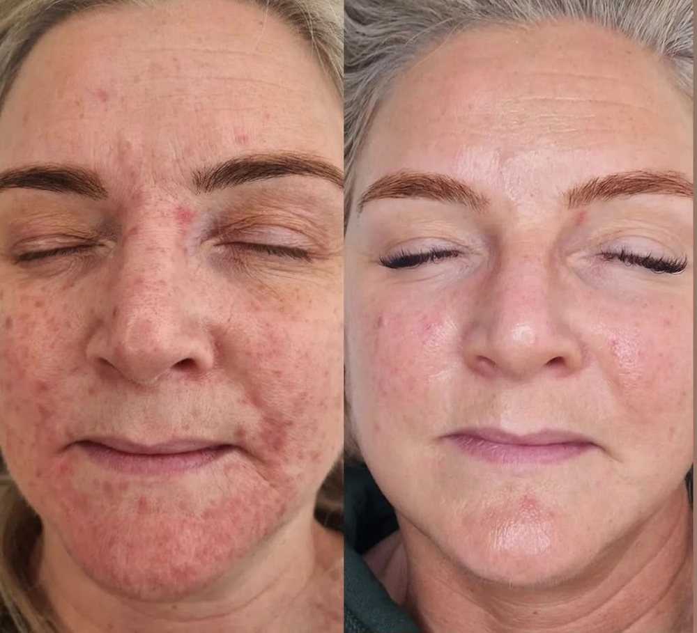 Unreines, gerötetes Hautbild vor und nach begleitender LED-Phototherapie