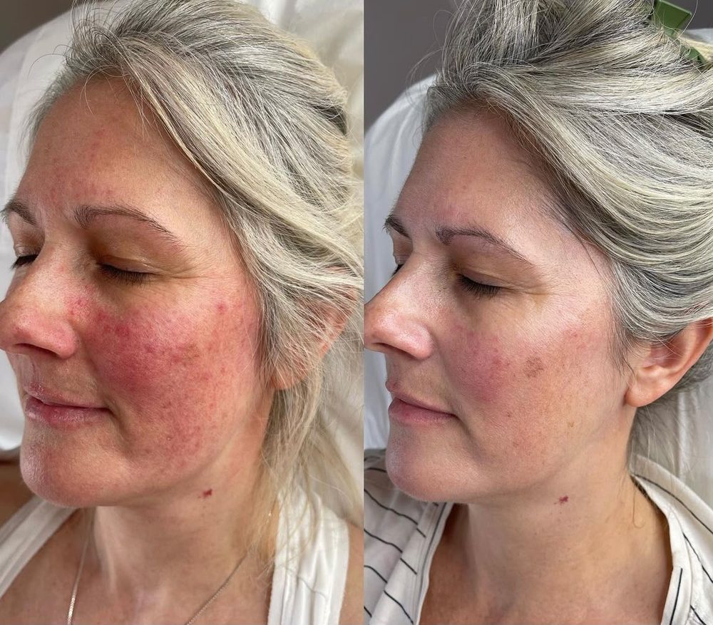Rötungen und Rosazea-Neigung an der Wange vor und nach begleitender Phototherapie