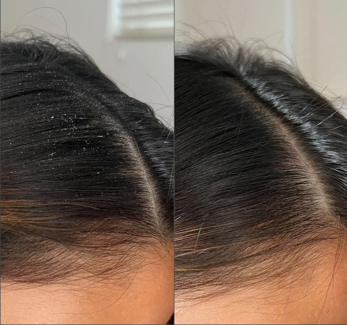 Scalp Detox Ergebnis – Kopfhaut mit Schuppen vor der Behandlung (links) und nach der Behandlungsserie (rechts)